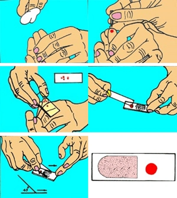 Malarial Parasite
(
Spot
Method)