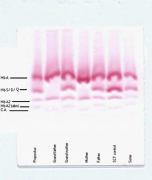 HB Electrophoresis (Cellulose Acetate)
