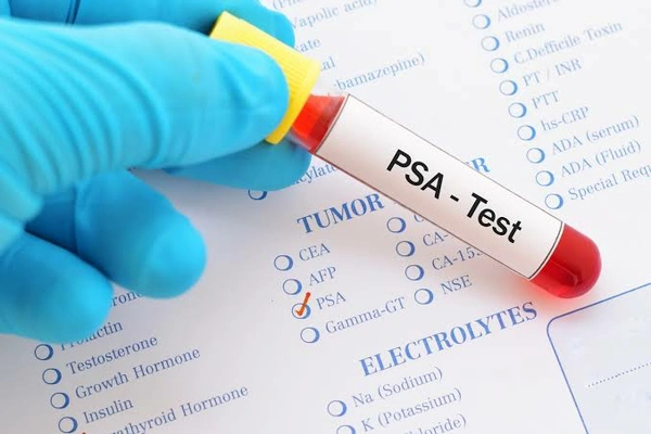 Prostate Specific Antigen