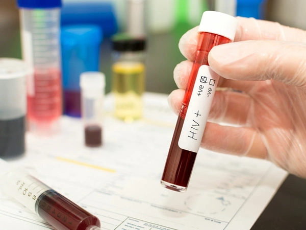 HIV 1 & II BY Western Blot