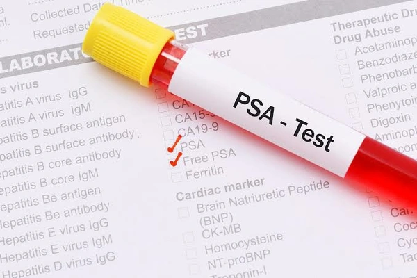 Free Prostate Specific Antigen