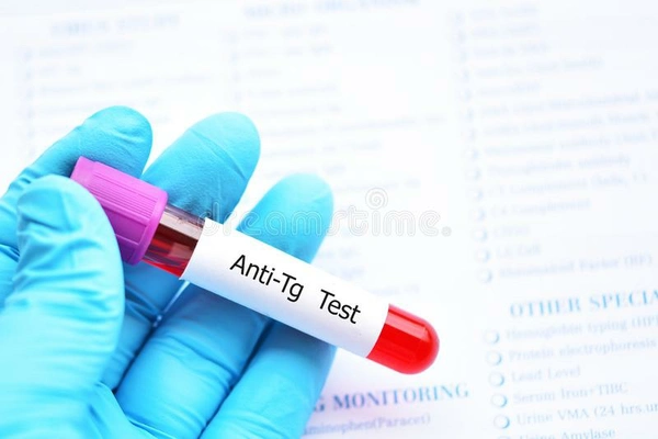 Anti Thyroid
Antibodies
(ATAB)