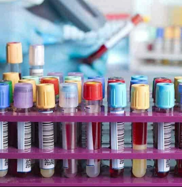 Anti Thyroidglobulin Antibody ( Anti TG )