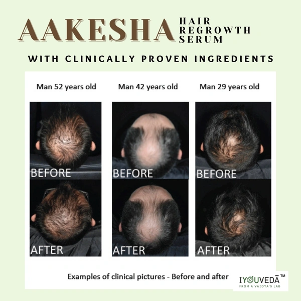 AAKESHA HAIR REGROWTH SERUM  - 15ml, White