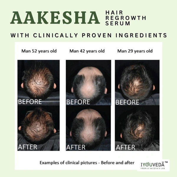 Aakesha Hair Regrowth Serum 1 Month Pack - 45ml