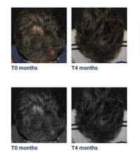 3 Month Pack Aaranga Grey Reversal Hair Serum  - White, 120 ml