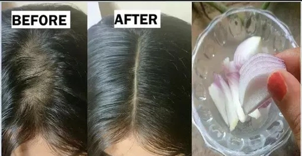Red Onion Black Seed Oil & Shampoo Ultimate Hair Care Kit (Shampoo + Hair Oil) (2 Items in the set)