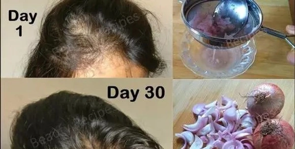 Red Onion Black Seed Oil & Shampoo Ultimate Hair Care Kit (Shampoo + Hair Oil) (2 Items in the set)
