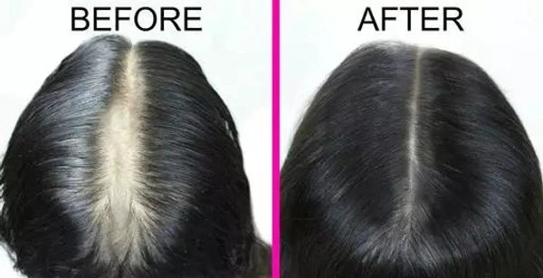 Red Onion Black Seed Oil & Shampoo Ultimate Hair Care Kit (Shampoo + Hair Oil) (2 Items in the set)