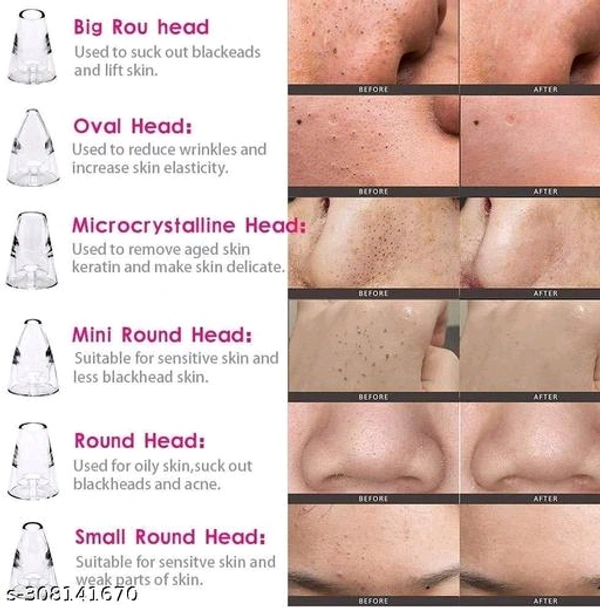 Classic Acne PCENF5334  Treatment Devices*Capacity: 150gIdeal For: UnisexNet Quantity (N): 1Dispatch: 2 Days*Proof of Safe Delivery! Click to know on Safety Standards of Delivery Partners- https://ltl.sh/y_nZrAV3