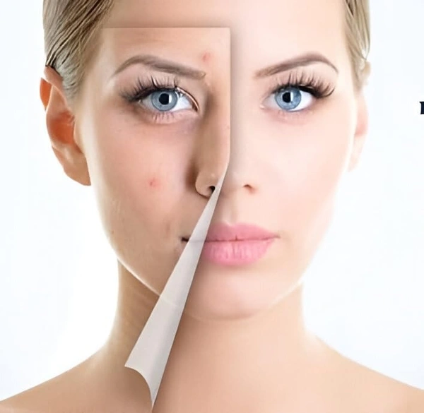 Galderma Biluma Skin Brightening Cream