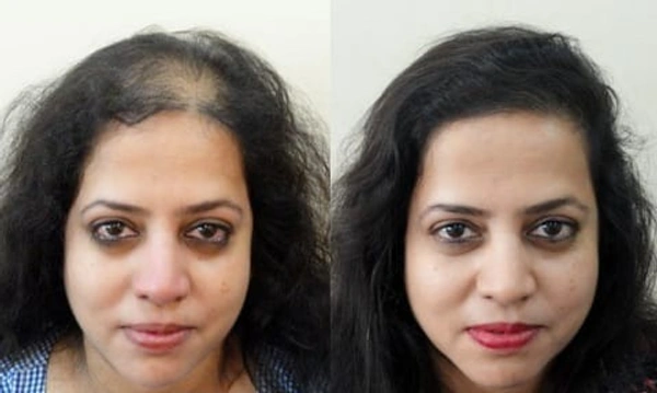 Adivasi Hair Oil & Shampoo – Herbal Solution for Hairfall & Hair Growth - 