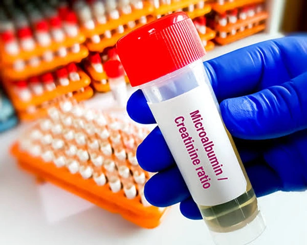 Urine Microalbumin 