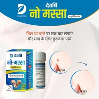 Devrishi Ayurveda Devrishi No-Massa (5gm) Warts Remover Ointment for Men and Women