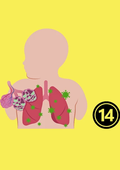 Pneumococcal-14 Vaccine