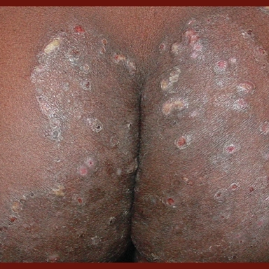 Fungal Infection