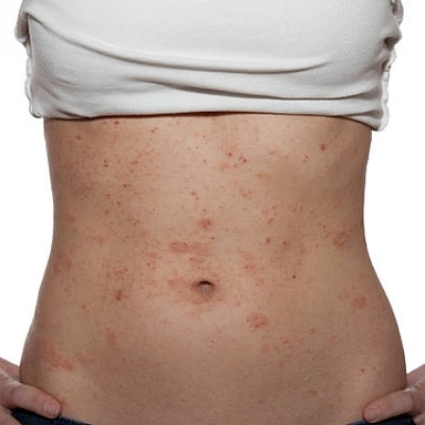 Skin Allergy