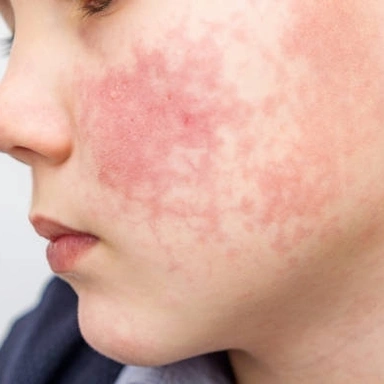 Allergy