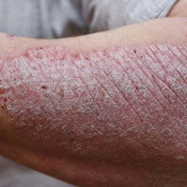 Psoriasis