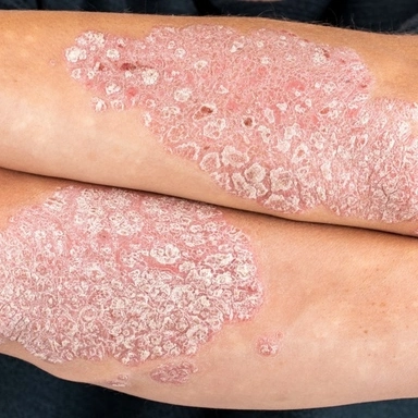 Psoriasis Skin Allergy