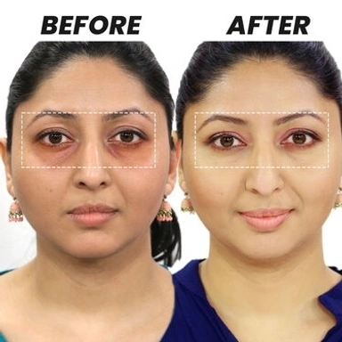 Dark Circle Treatment