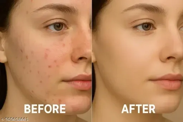 detan facepack for skin glowing oil control acne pimples