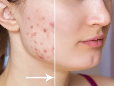 SALICYLIC PEEL