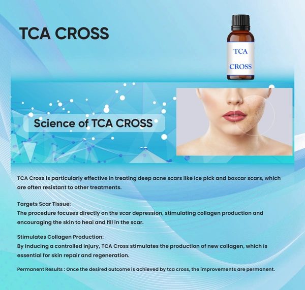 A TCA Cross 50% -  Acne Scars Solution
