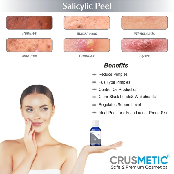 Crusmetic Salicylic Peel 30% - Advanced Acne Treatment Formula