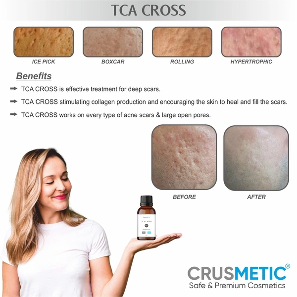 A TCA Cross 80% -  Acne Scars Solution