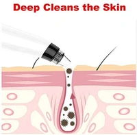 Derma Suction Blackhead Remover