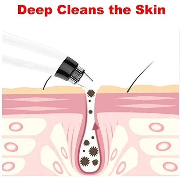 Derma Suction Blackhead Remover