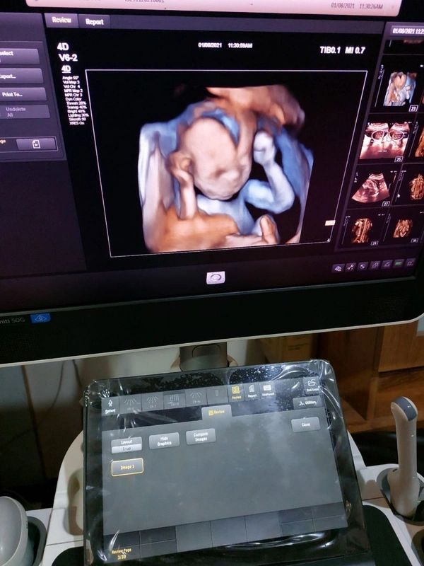 Philips Affinity 50 Ultrasound Color Doppler - Static / Mobile, White