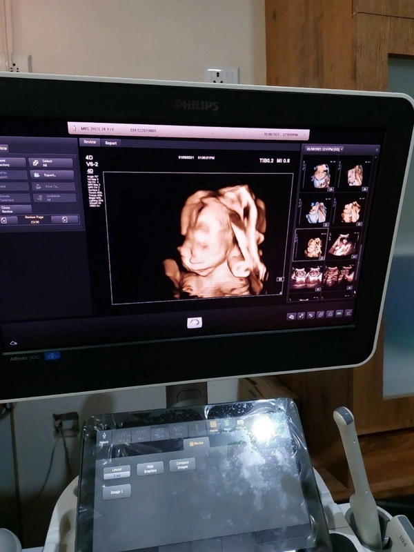 Philips Affinity 50 Ultrasound Color Doppler - Static / Mobile, White